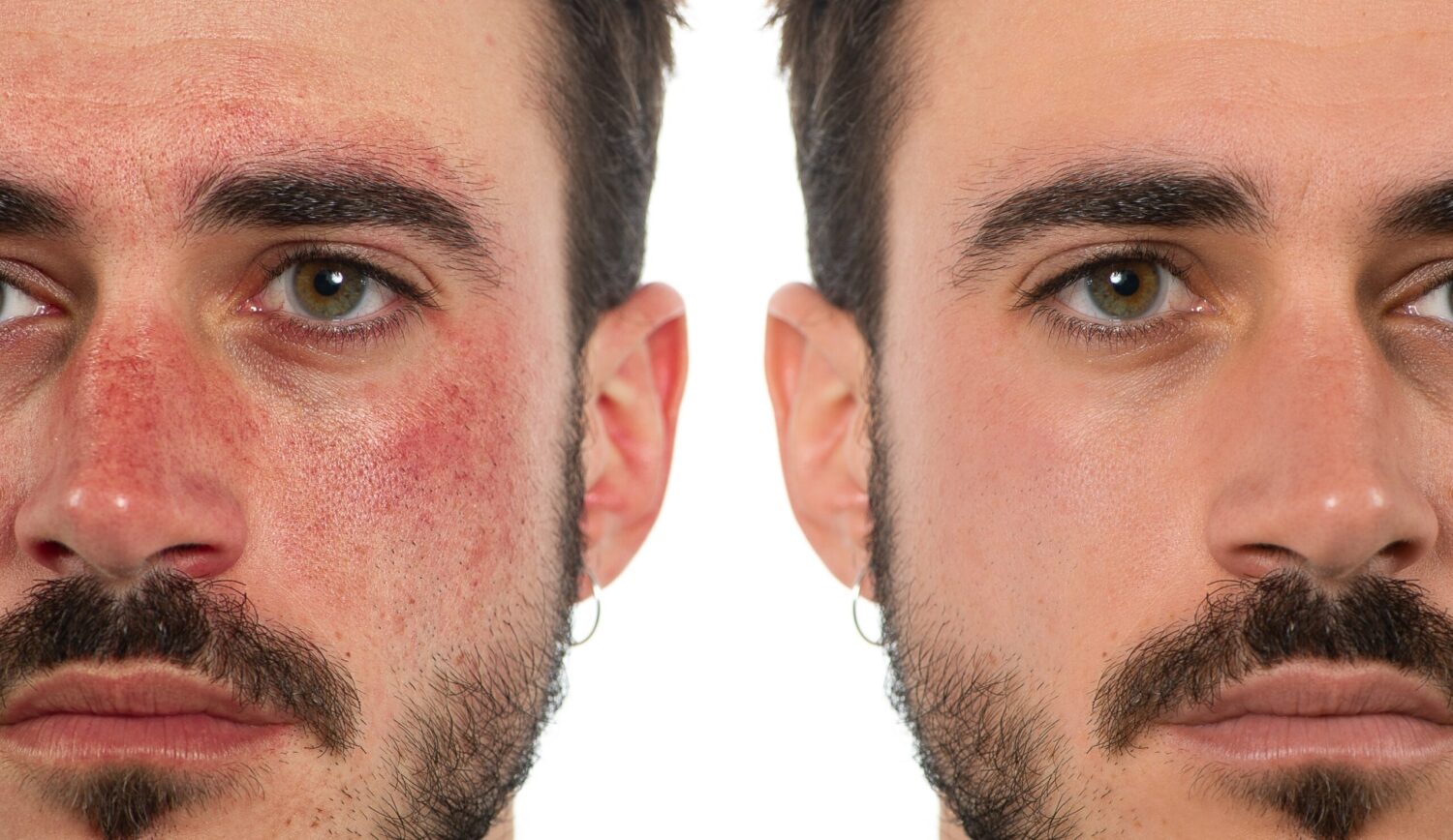 Rosacea treatment at Aeternum Aesthetics